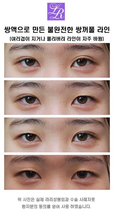 Double eyelid surgery with an inner crease as charming as an outer crease image 2