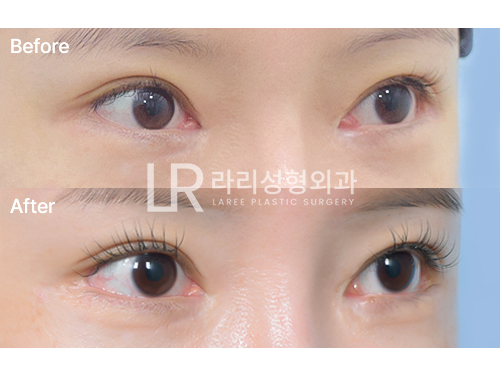 [라리성형외과] 뒷트임수술(재수술, 재재수술) 회복 기간 중이라면 걱정하지 말자 관련 이미지 4