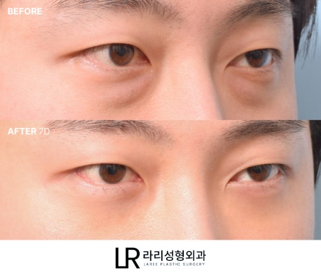 [라리성형외과] 하루(1DAY) 투자로 예뻐지는 라리성형외과의 퀵 눈밑지방재배치수술 관련 이미지 7