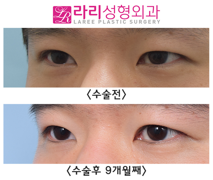 [Rari Plastic Surgery] Revision Surgery to Remove a Double Eyelid Is Also Possible. image 2