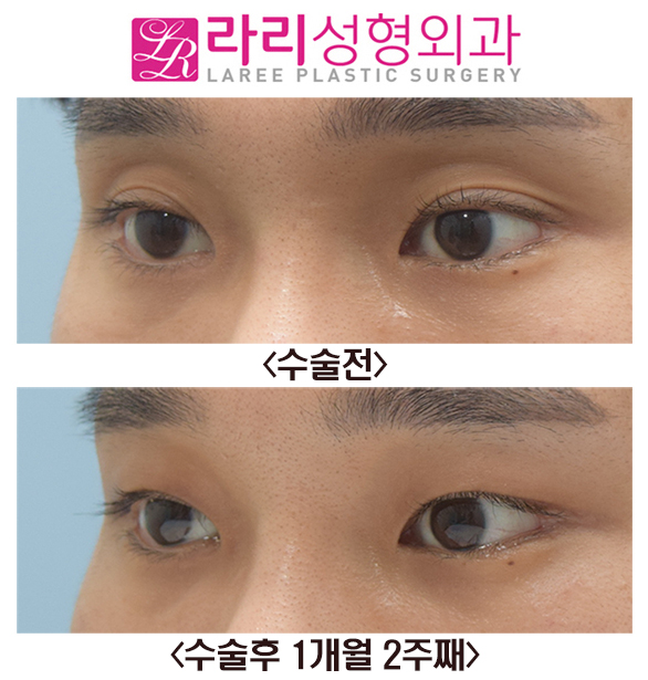 [Lari Plastic Surgery] Sunken Upper Eyelid Fat Grafting + Double Eyelid Removal Before and After Surgery image 4