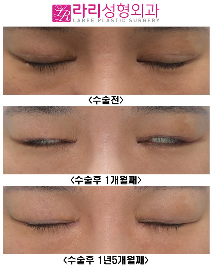 [Rari Plastic Surgery] Watching the Progress Before and After Double Eyelid Removal Surgery image 4