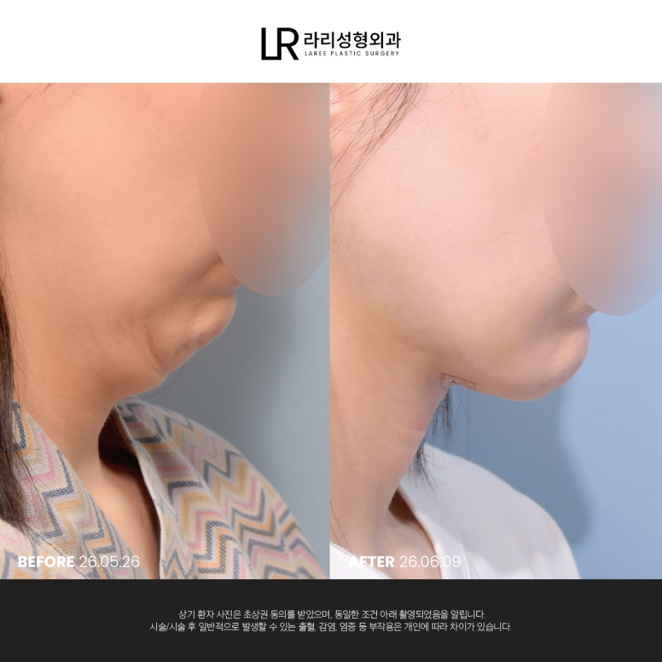 [라리성형외과] 이중턱 지방 흡입만으로는 아쉬운 얼굴 라인, 이중턱 근육 묶기도 같이 하면 효과가 두 배! 관련 이미지 6
