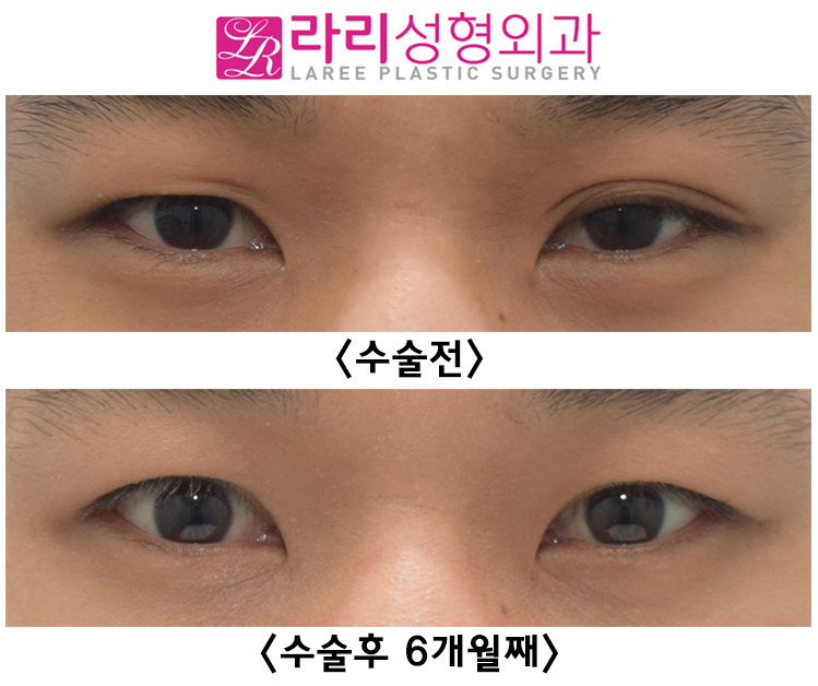 [Lari Plastic Surgery] See the Process of Correcting Uneven Eyes After Double Eyelid Removal Surgery image 5