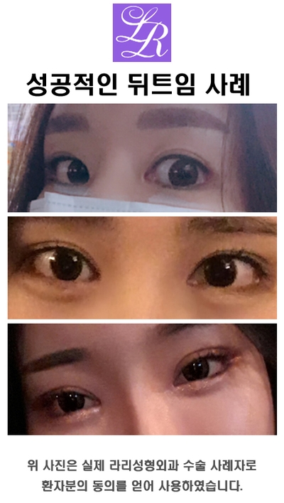 Are You Curious About Canthoplasty for Men? image 5