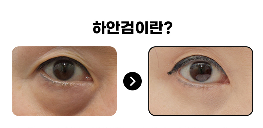 [라리성형외과] 하안검성형 VS 눈밑지방재배치(제거) : 어떤 수술을 해야 할까? 관련 이미지 1