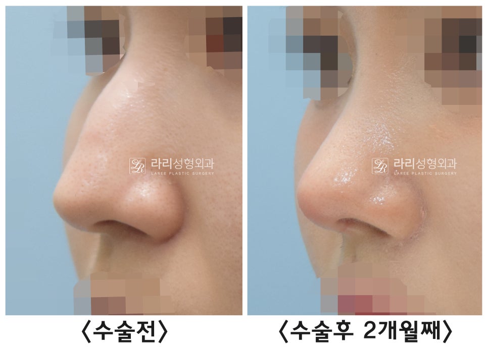 [라리성형외과] 절골을 포함한 매부리코 교정 수술(비순각 교정) 관련 이미지 6