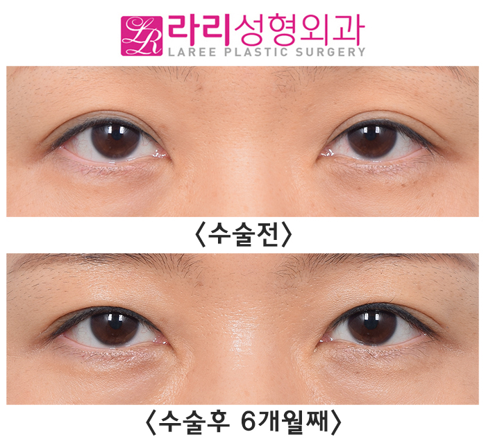 [라리성형외과] 흐릿한 눈, 소세지 쌍꺼풀 인라인 속쌍으로 깔끔하게 관련 이미지 4