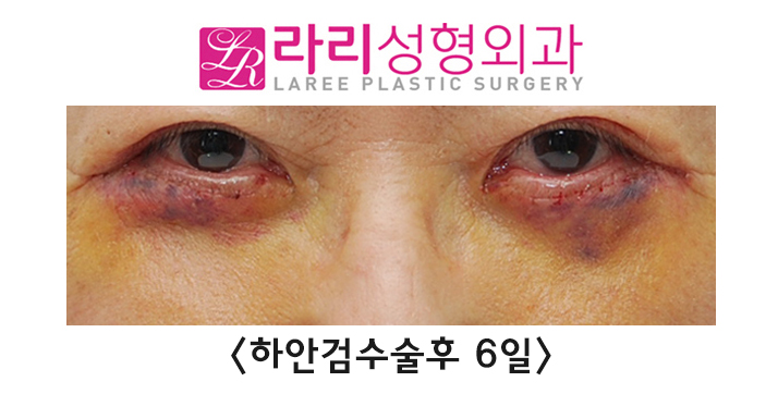 [라리성형외과] 노화로 나타나는 노인성 안검외반의 교정 관련 이미지 3
