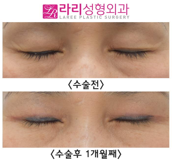 [라리성형외과] 처진 피부에 가려진 내 큰 눈 찾아주는 상안검수술 전후 사진 관련 이미지 3
