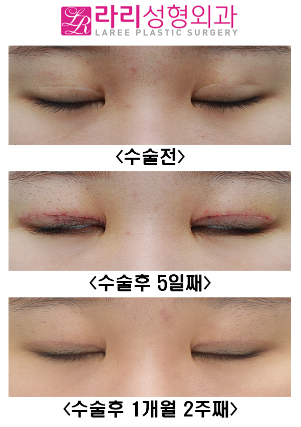 [Lari Plastic Surgery] Revision Double Eyelid Surgery and ROOF Fat Removal image 3