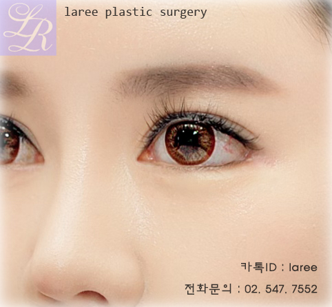 Eyes Suited to an In-Out Line Double Eyelid Design image 5