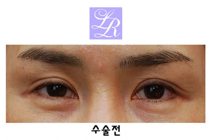 짝눈교정방법 중(쌍꺼풀재수술 + 눈매교정) 확인해야 될 사항 관련 이미지 1