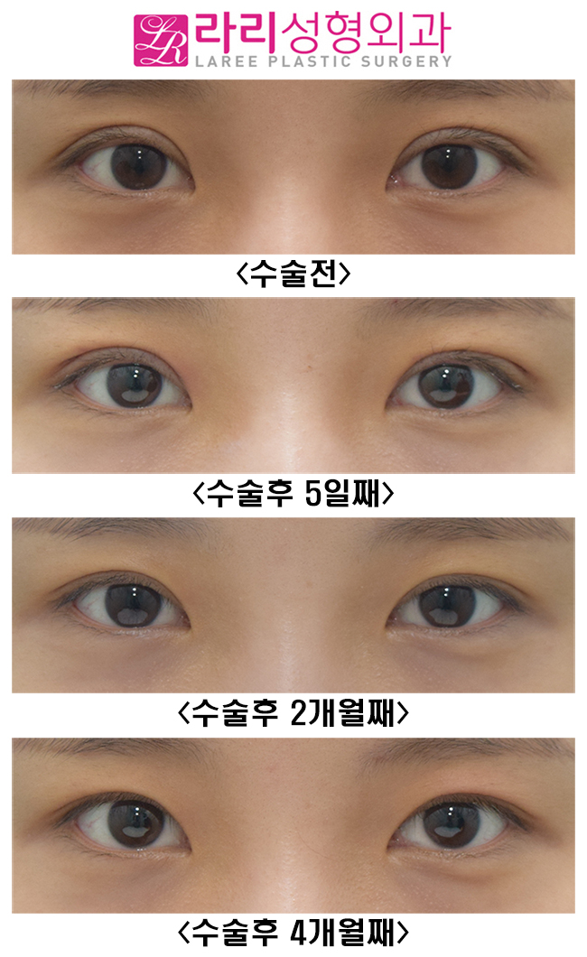 [Lari Plastic Surgery] Revision Double Eyelid Surgery to Correct Mucosal Exposure Caused by Sausage-Like Eyelids image 3