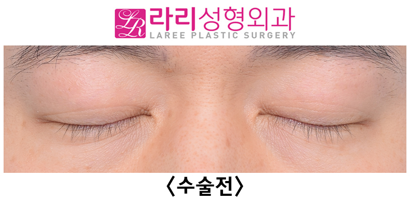 [라리성형외과] 쌍꺼풀없애기 수술 눈안감김(토안)의 원인이 정말 피부절제 때문일까? - 무절제쌍꺼풀없애기 관련 이미지 8