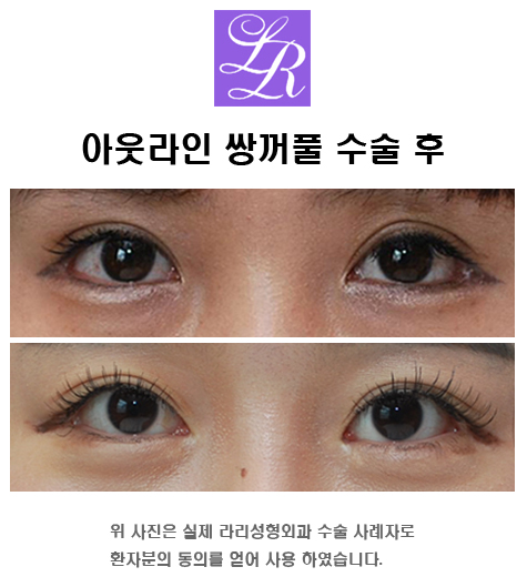 쌍꺼풀만들기 - 쌍액, 쌍테, 쌍수 뭘 해야하죠? 관련 이미지 5
