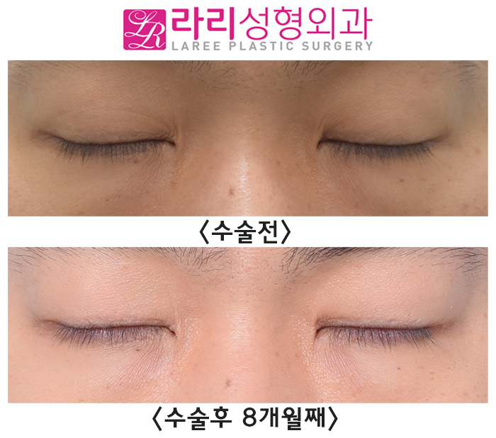 [라리성형외과] 쌍꺼풀없애는수술, 남자라면 꼭 고려해 보세요. 관련 이미지 4