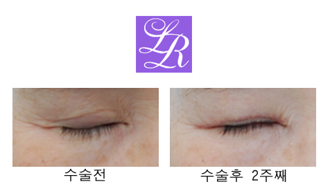 쌍꺼풀 푸는 수술/ 없애기 차이점은? 관련 이미지 2