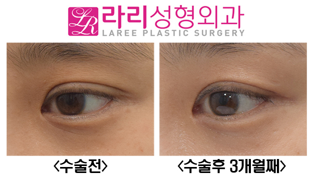 [Lari Plastic Surgery] Cutting Away the Epicanthal Fold: No-Canthus-Opening Surgery Instead of Epicanthoplasty image 2
