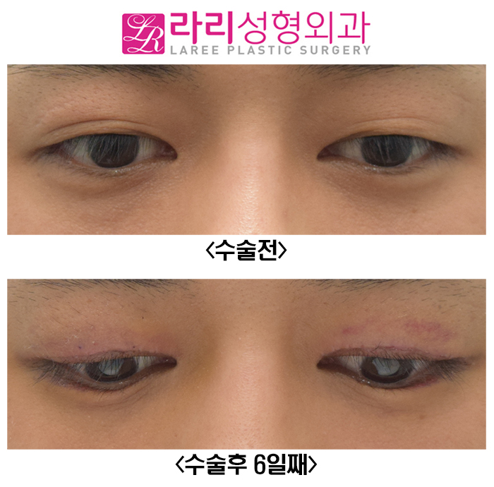 [라리성형외과] 쌍꺼풀없애는수술 전후사진 일주일이면 실밥 제거 관련 이미지 4