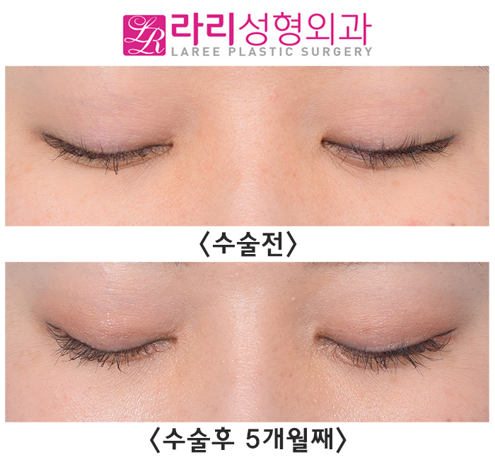 [Rari Plastic Surgery] First Eye Surgery (Non-incisional eyelid correction, epicanthoplasty, canthoplasty) Before-and-After Photos image 4