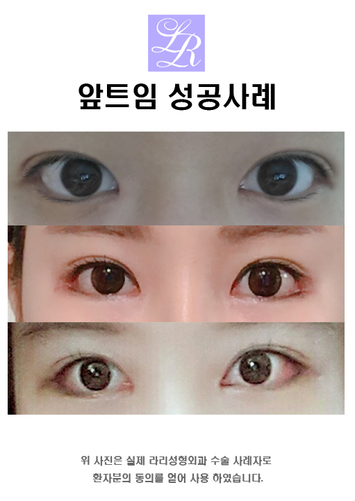 몽고주름없애는 앞트임후기 관련 이미지 7
