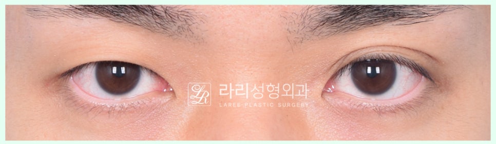 [Lari Plastic Surgery] Removing a Visible Double Eyelid (Double Eyelid Reversal Surgery), From Natural Double Eyelids to Surgical Double Eyelids: A to Z image 4