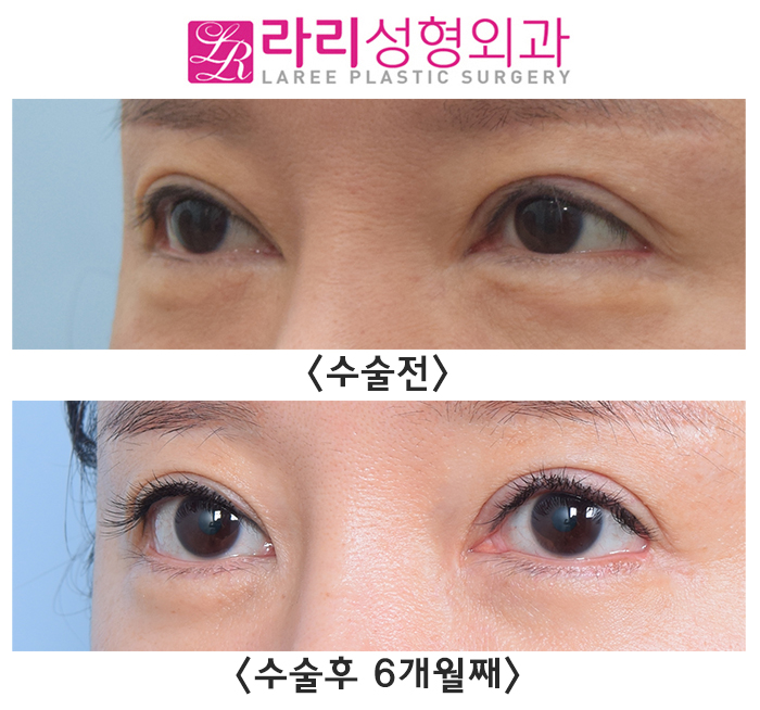 [라리성형외과] 몽고주름을 살리는 앞트임복원 관련 이미지 2
