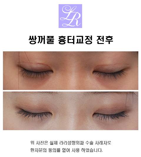What Side Effects Can Occur After Double Eyelid Surgery? image 3
