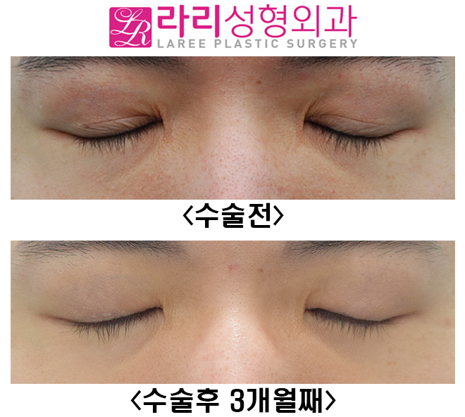 [Lari Plastic Surgery] Before-and-After Photos of Male Double Eyelid Removal Surgery at 3 Months image 2