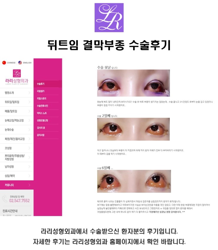 Is Swelling After Lateral Canthoplasty, Conjunctival Edema, a Side Effect? image 6