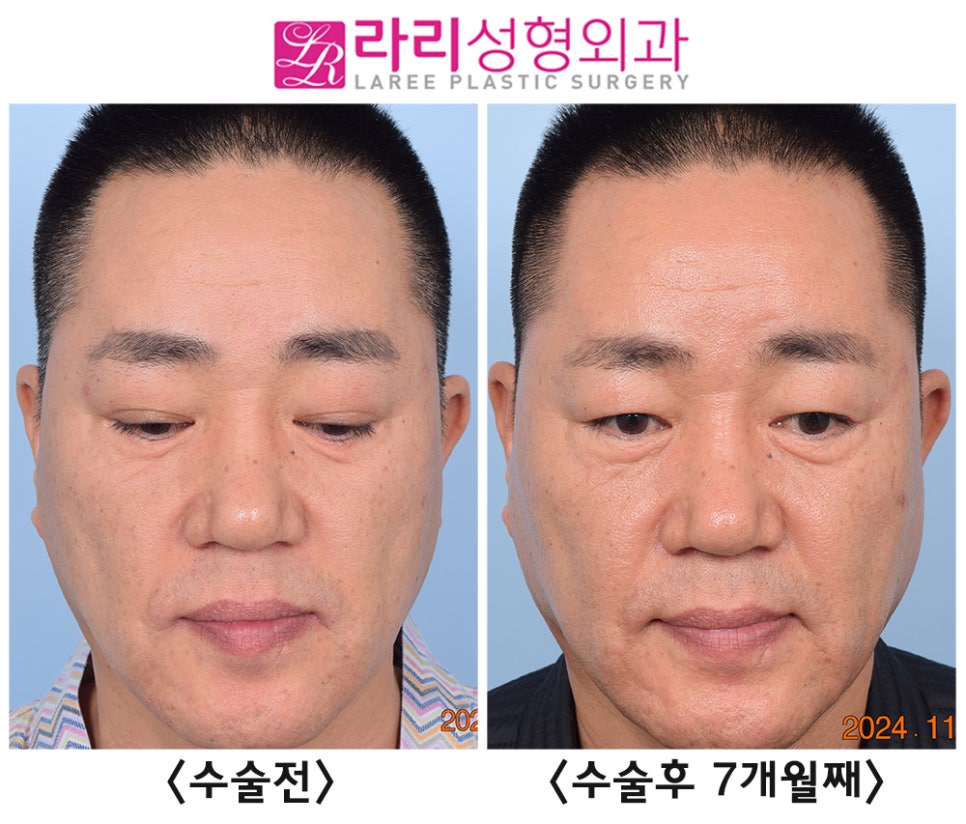[Rari Plastic Surgery] Comparing Before and After Photos of Double Eyelid Removal Surgery (Double Eyelid Disappearance + Mucosal Ptosis Correction) image 2