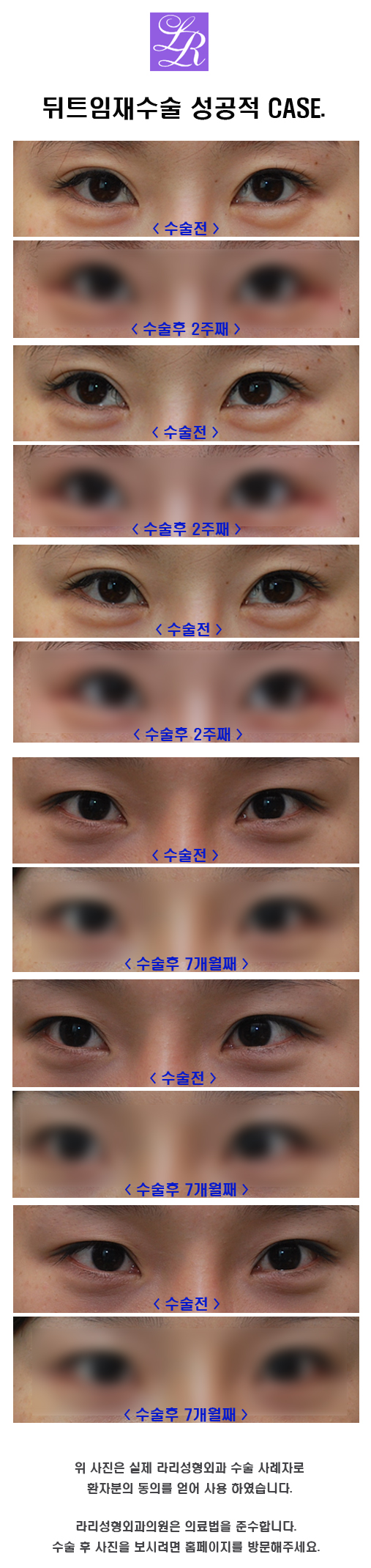 Where is the best place for revision canthoplasty? image 6