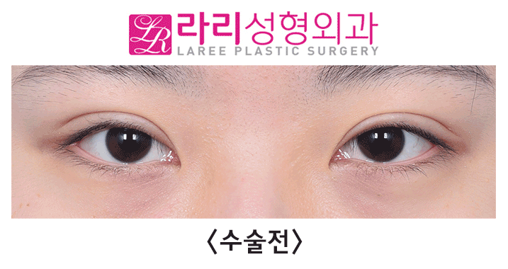 [라리성형외과] 6개월 차 자연스럽지만 티나는 눈꼬리내리기뒤트임 수술 전후 사진 관련 이미지 4