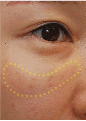 [Lali Plastic Surgery] Comparison Photos of the Before-and-After Differences of Epicanthoplasty Restoration, Revision Lateral Canthoplasty, and Fat Graft Removal Surgery (Under-Eye + Cheekbone Area) image 5