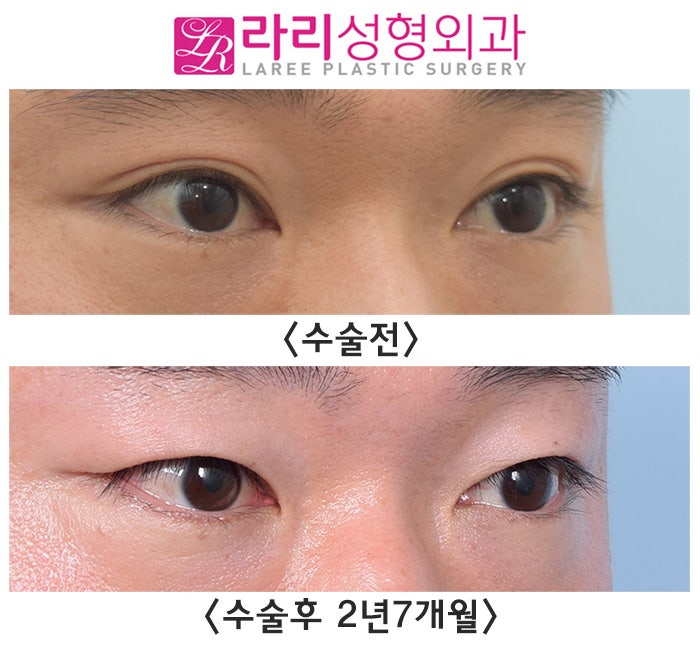 [라리성형외과] 자연쌍꺼풀없애기 2년 이상 장기 경과 전후 사진 관련 이미지 5