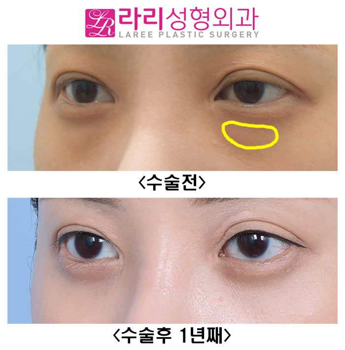 [Lari Plastic Surgery] Not a Lower Eyelid Fat Repositioning Surgery That Quickly Comes Back, but a Long-Lasting One image 5