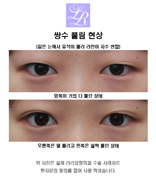 About Incision-Method Double Eyelid Surgery, Suture-Method Loosening, and Swelling image 5