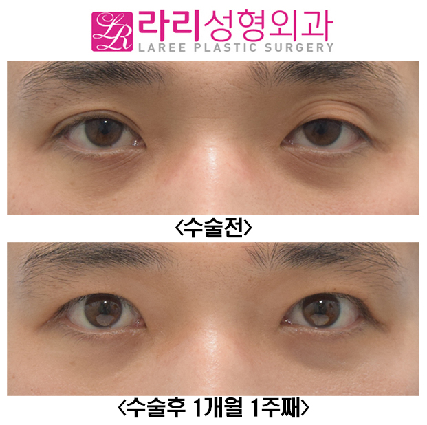 [Lari Plastic Surgery] Before-and-After Photos of Male Ptosis Correction Surgery image 1
