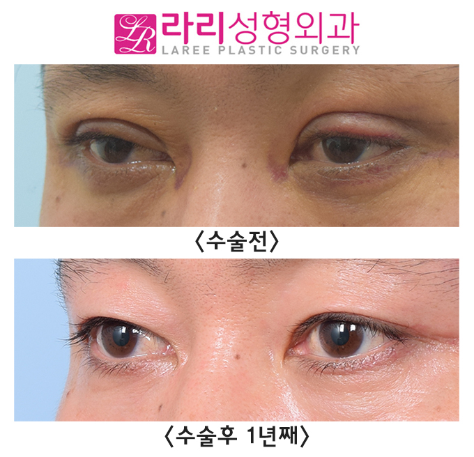 [라리성형외과] 급속교정 쌍꺼풀재수술 필요한 눈, 가능한 관련 이미지 3