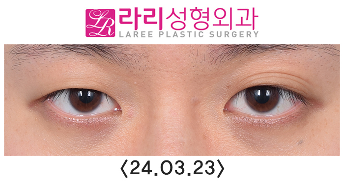 [라리성형외과] 쌍꺼풀없애는수술 후 필요에 의한 재교정과 회복 과정 기간별 사진 관련 이미지 1