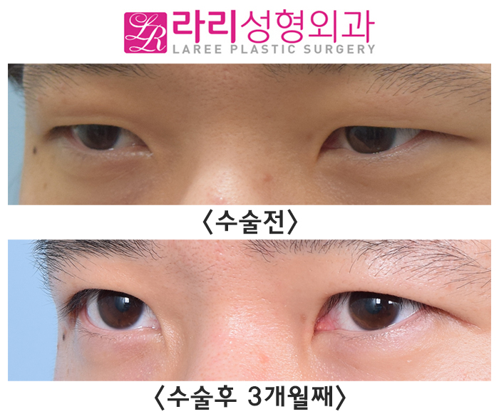 [Lari Plastic Surgery] Before and After Double-Incision Non-Incisional Eyelid Correction Surgery for Men That Makes the Eyes Exactly Twice as Big image 1