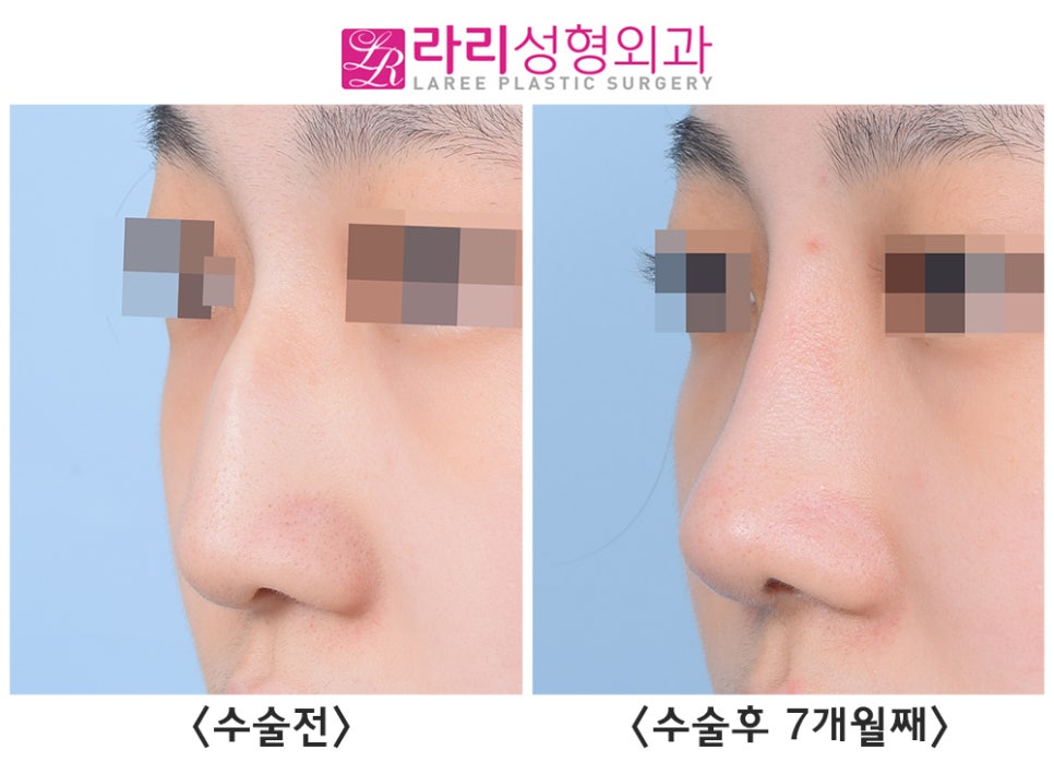 [라리성형외과] 선천성 매부리코, 첫코성형으로 고민하지 말고 매끄럽게 바꾸자 관련 이미지 3