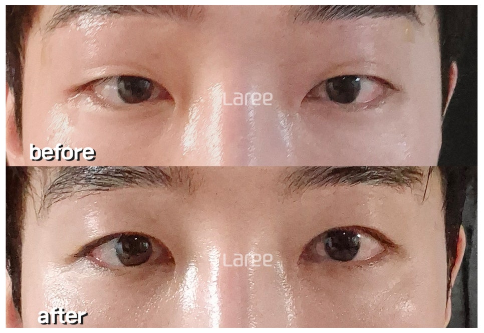 [Lari Plastic Surgery] The Real Way to Make Eyes Bigger: Eyelid Correction Surgery Is Needed Before Canthoplasty. image 5