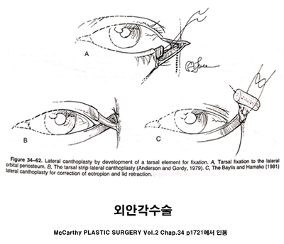 외안각고정술 뜻 - 뒤트임의 한 방법이죠 관련 이미지 1