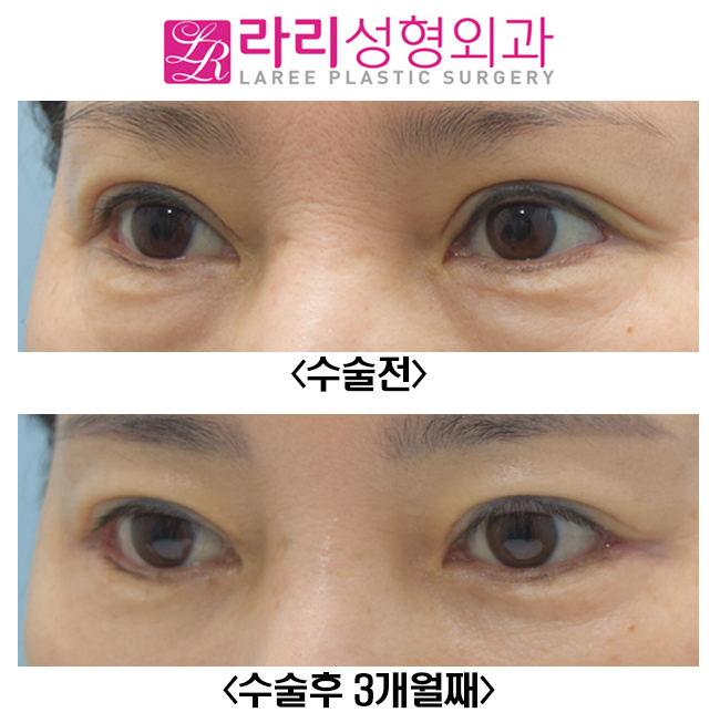[Lari Plastic Surgery] Before-and-After Photos of Correcting Sausage-like Double Eyelids with Revision Double Eyelid Surgery image 3