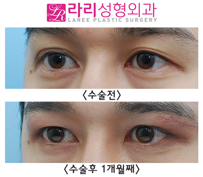 [라리성형외과] 겹쌍꺼풀 처진 눈 쌍꺼풀없애기, 그리고 눈썹하거상수술 전후 효과 관련 이미지 2