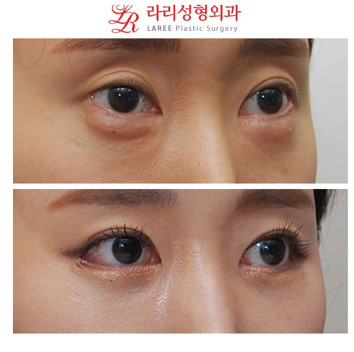 [Big-Eyed Canthoplasty] Revision Surgery for Lateral Canthoplasty to Lower the Outer Eye Corner / Revision Surgery for Lowering the Outer Eye Corner, Before-and-After Photos of Under-Eye Fat Repositioning image 5