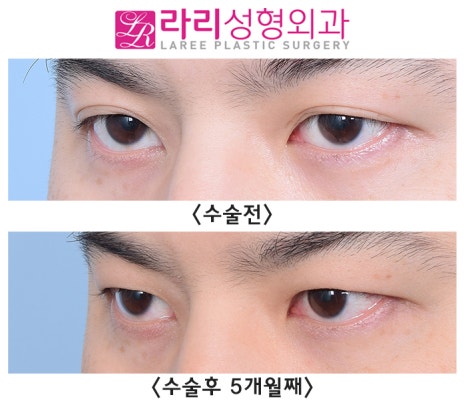 [Lari Plastic Surgery] Completely monolid, removing a natural double eyelid: the eyes close well too. image 3