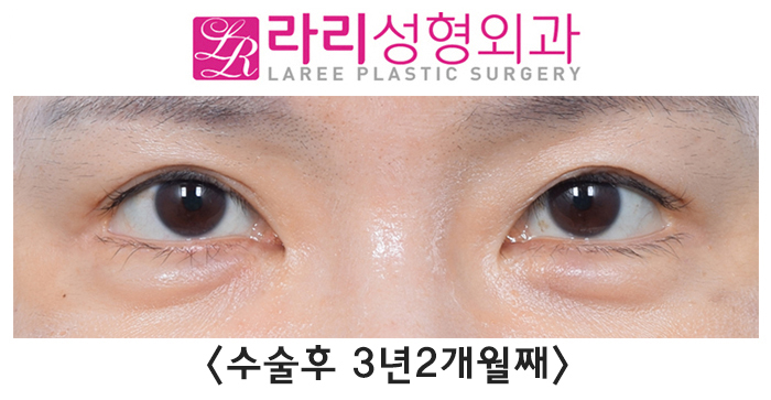[라리성형외과] "절개쌍꺼풀재수술, 앞트임 복원 후 앞트임재수술, 눈꼬리내리기 뒤트임재수술" 효과 한 번에 보기 관련 이미지 2